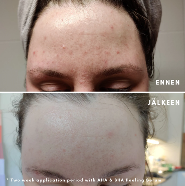 The Ordinary AHA 30% + BHA 2% Peeling Solution