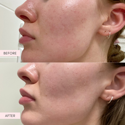 The Ordinary AHA 30% + BHA 2% Peeling Solution